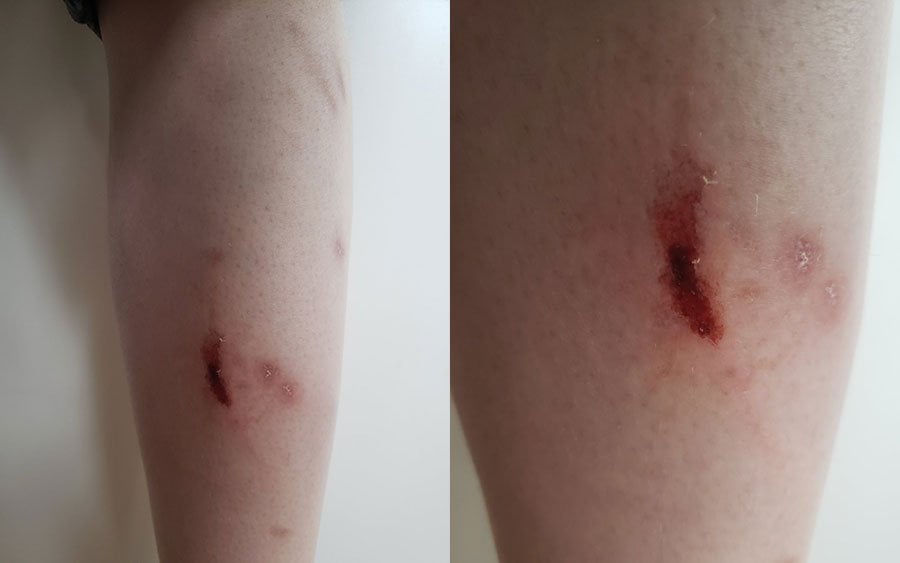 Two photos of a wound on my bottom leg.